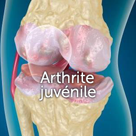 arthrite juvenile